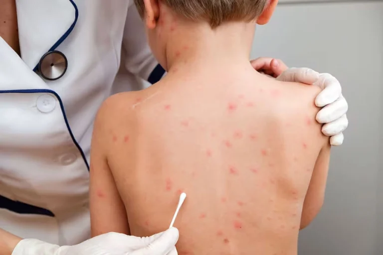 SARAMPIÓN EN ENTRE RÍOS: INSTAN A COMPLETAR ESQUEMAS DE VACUNACIÓN PARA PREVENIR